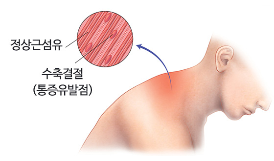 근초성 통증 증후군의 원인과 증상은 무엇입니까? 4